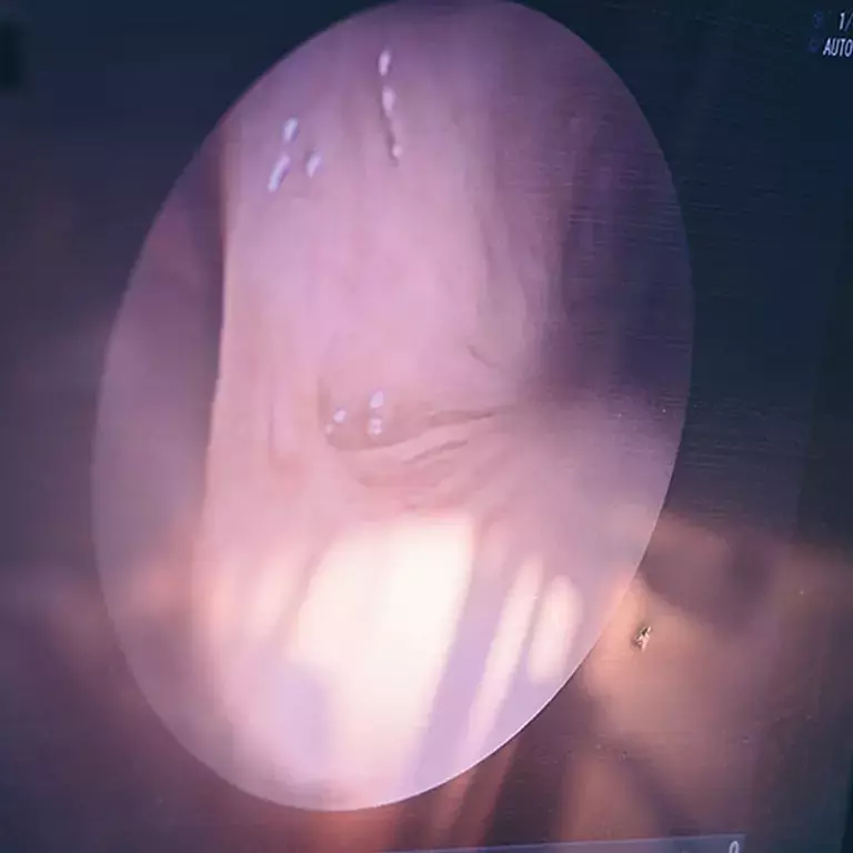 OpTek - Fiber Processing for Endoscopy and PICC Positioning