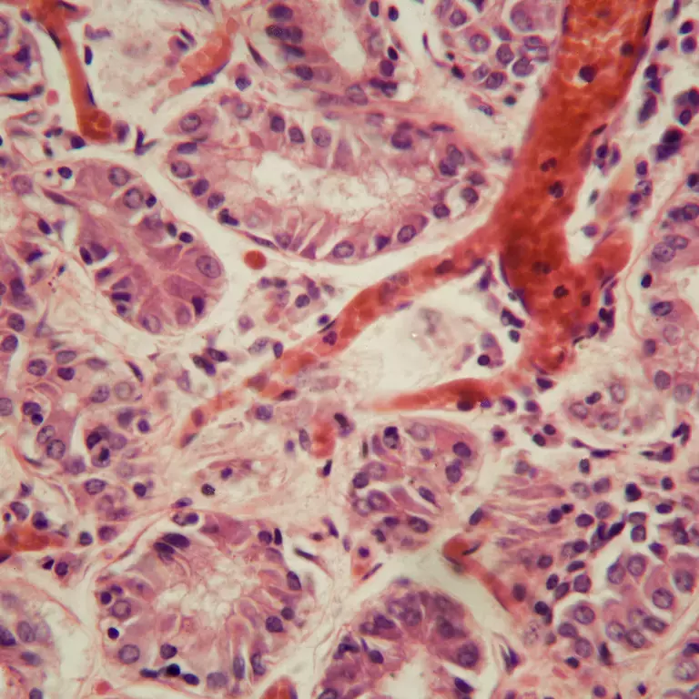 OpTek - Fiber Processing for Endovenous Laser Ablation and Pulmonary Embolism