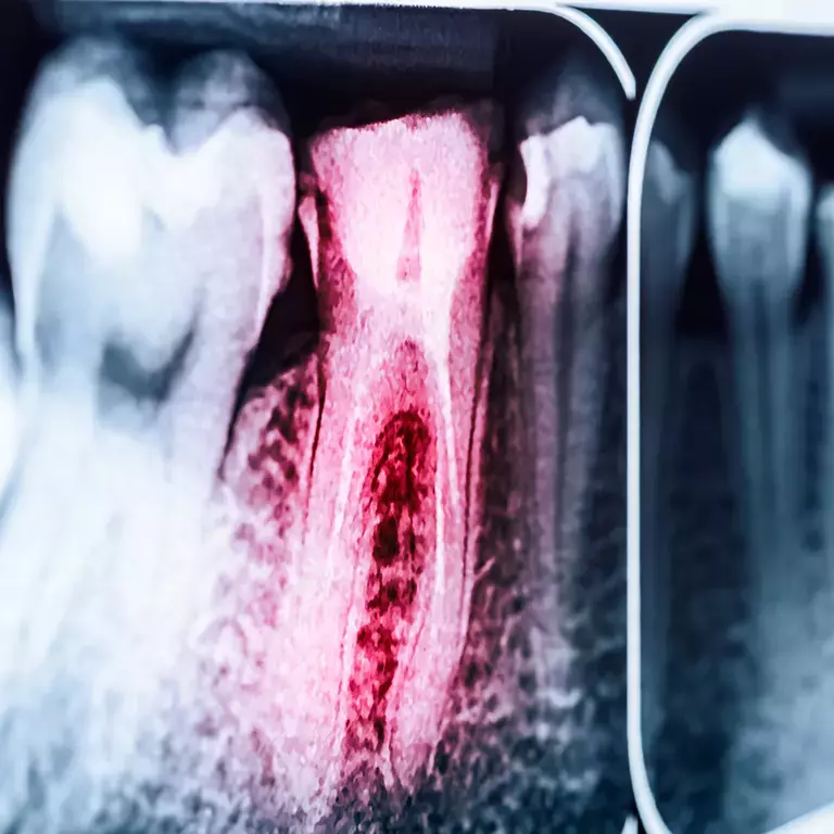 OpTek - Fiber Processing for Oral and Endodontic Procedures