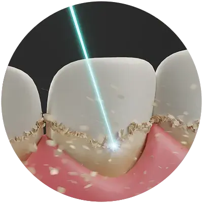 Bacterial reduction with laser fiber tips