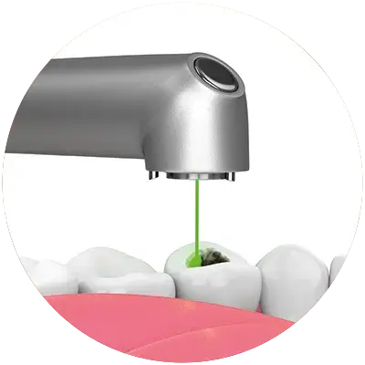 Fiber laser tips for endodontic cleaning