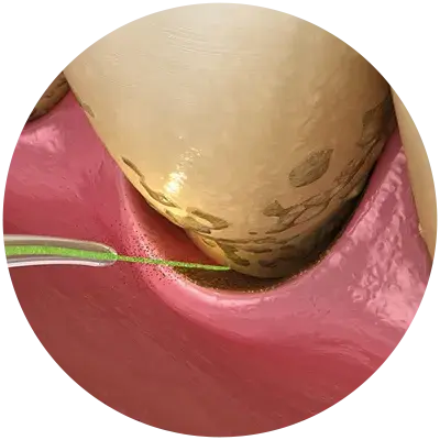 Fiber tips for periodontal therapy