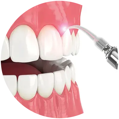 Fiber laser tips for soft tissue surgery