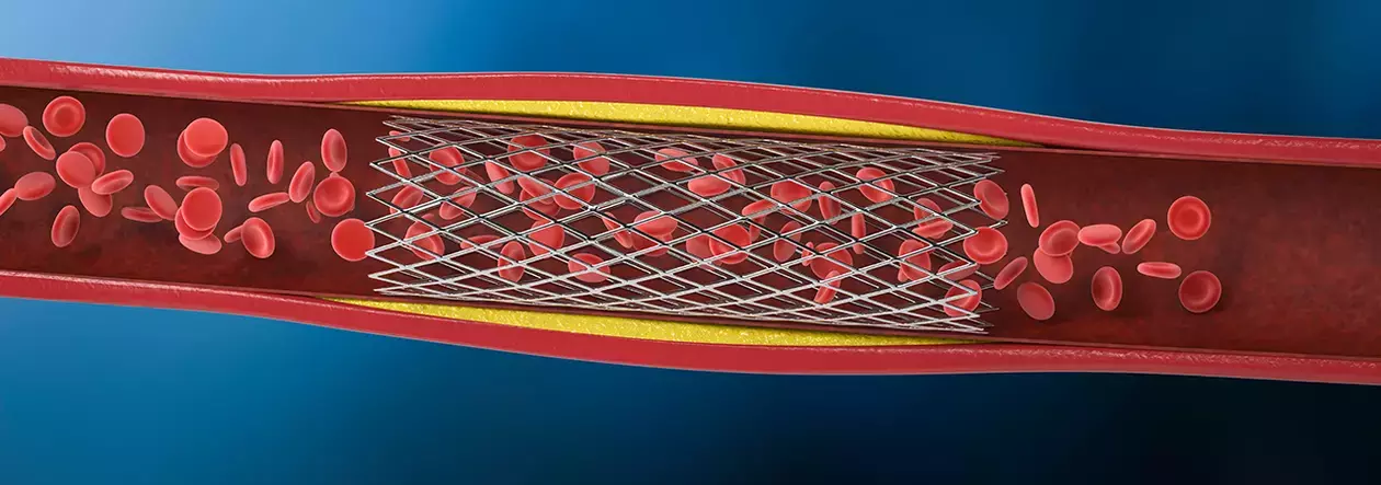 stent cutting