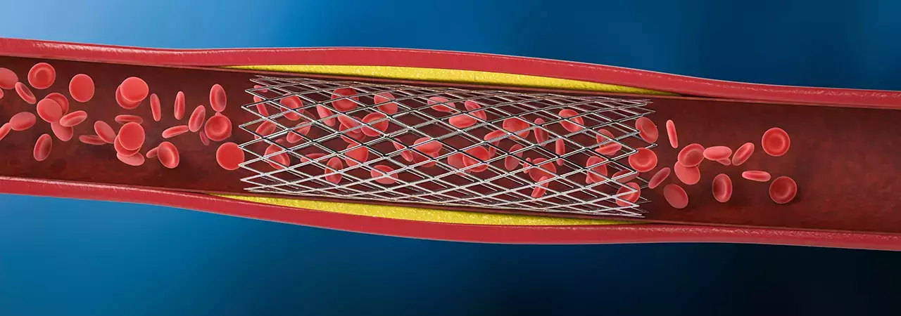 stent cutting